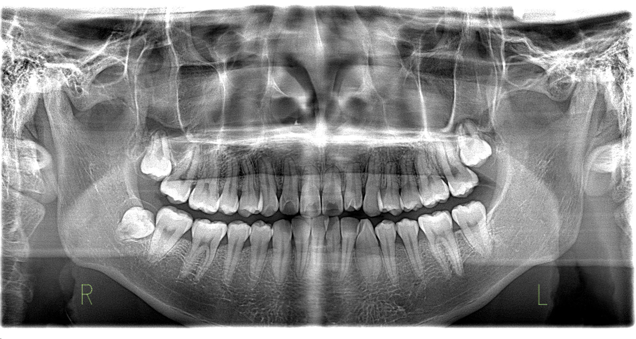 奥歯を起こす部分矯正の治療後のパノラマ画像